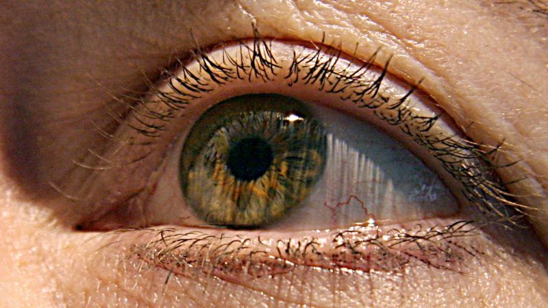 Alzheimers disease has co-aggregates of medin and amyloid