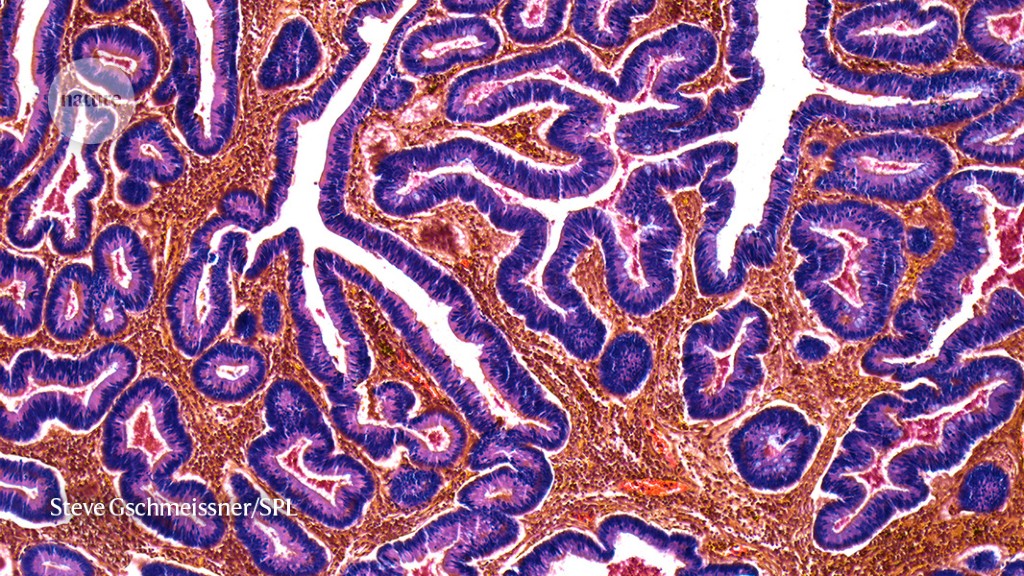 Growth is caused by Y chromosomal loss in cancer