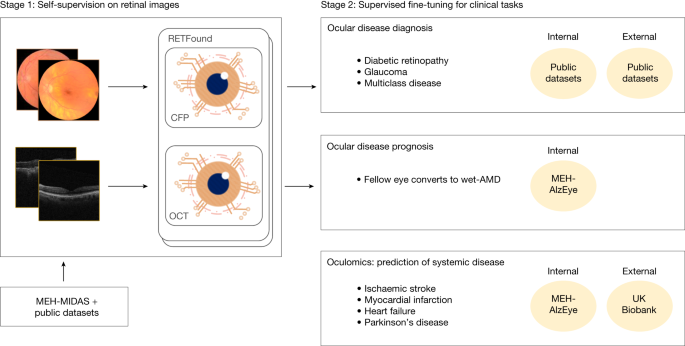 There is a correlation between eye disease and Parkinson’s
