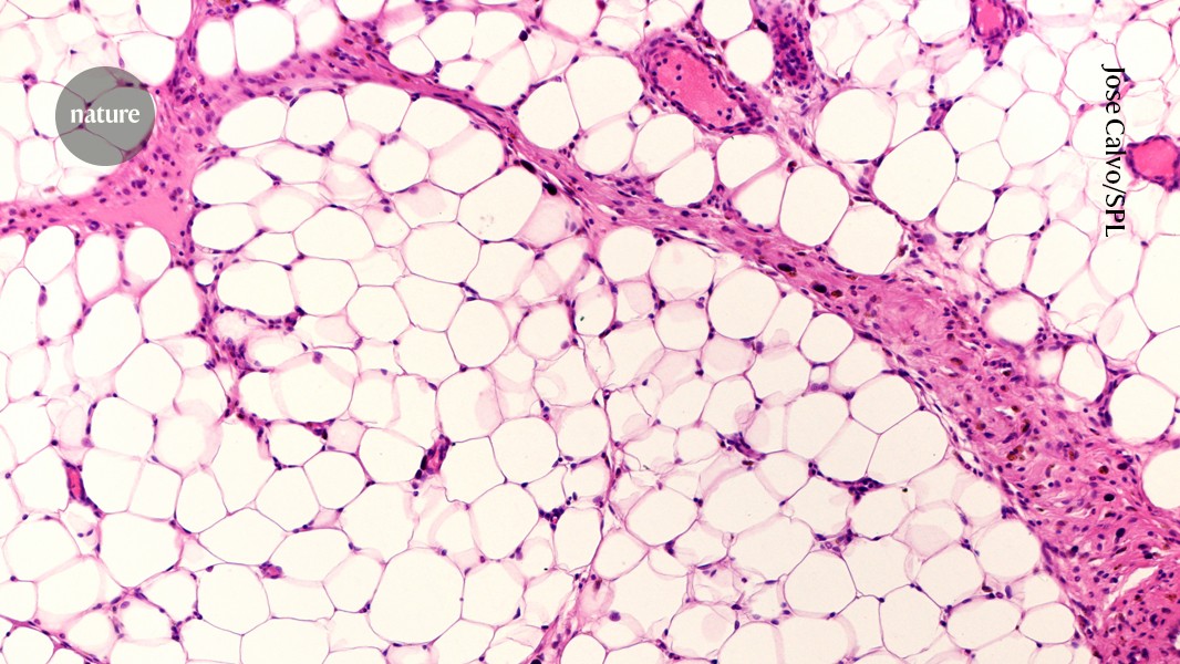 Is Obesity a disease in the age of Ozempic?
